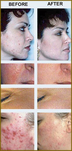 several before and after photos of rosacea treatments